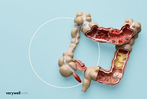 Colon Cancer Stages 0–4: Subtypes, Remission, Outlook