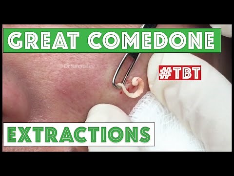 Greatest Blackheads and Whiteheads TBT