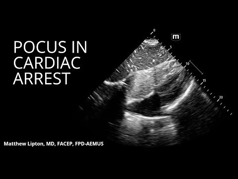 POCUS in cardiac arrest: A simple (yet evidence-based) algorithm