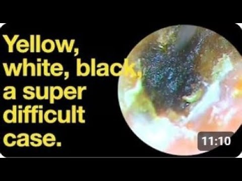 Satisfying Infected Ear Wax removal - Yellow, white, black, a super difficult case | audiologist