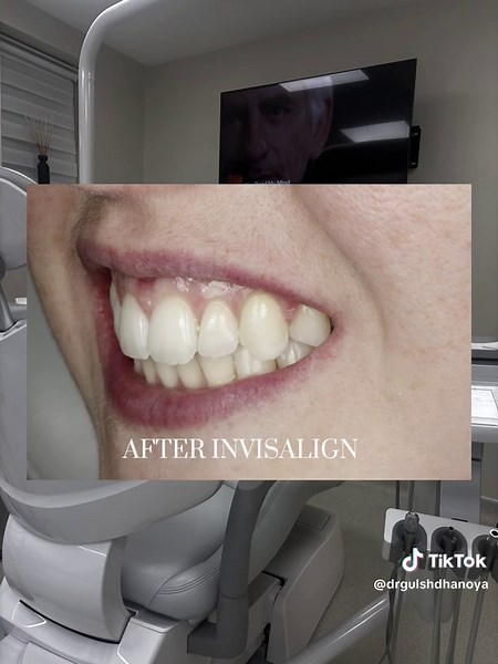 Transform Your Smile: Invisalign Before and After Results