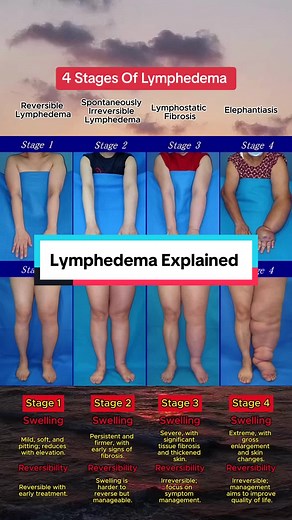 4 Stages of Lymphedema: What You Need to Know to Protect Your Health 🦵💪😳 @Zenhealth 🧐Lymphedema progresses through four clinically recognized stages, each with distinct characteristics in terms of swelling, tissue changes, and reversibility: 👉Stage 1: Reversible Lymphedema (Mild Stage) \t•\tCharacteristics: This stage involves mild swelling that may fluctuate throughout the day and is typically soft and pitting (leaves a dent when pressed). The swelling usually improves or disappears with e