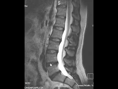How to Read an MRI Scan of the Lumbar Spine | First Look MRI