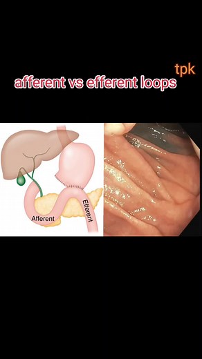 Understanding the Difference Between Afferent and Efferent Loops in Whipple Procedure