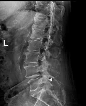 Bone tumor lumbar spine. MRI versus x-ray | First Look MRI