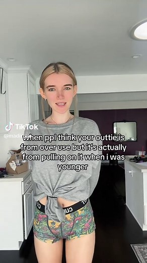 Understanding Outtie Belly Buttons and Their Causes