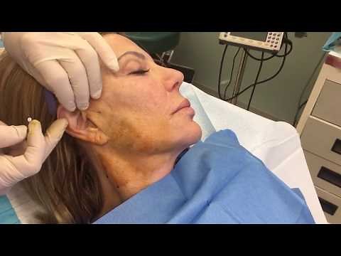 Thread Facelift Procedure with Dr. Steven Hopping at The Center for Cosmetic Surgery, Washington DC.