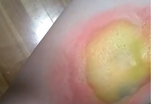 Huge Pus Filled Boil Popped