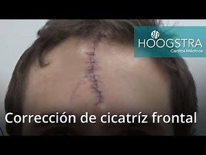 Corrección de cicatriz frontal (19038)