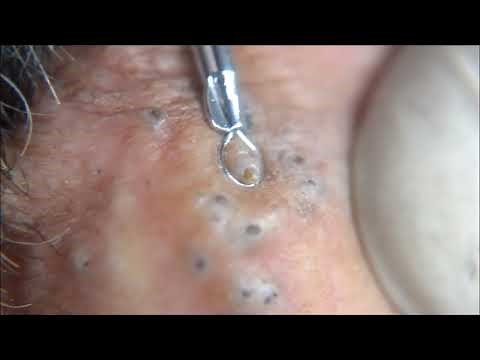 Blackheads Comedones - Behind extraction procedure