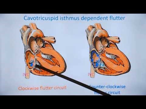 Atrial Flutter Recognition on ECG and Mechanism