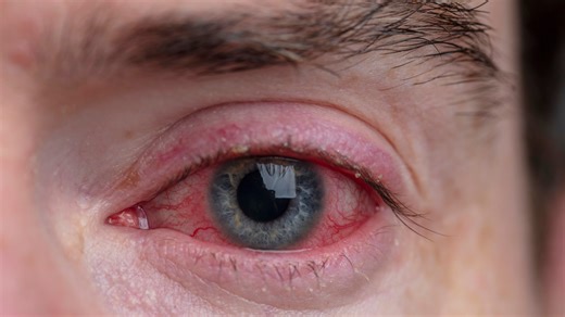 Doctors warn against trying 'unproven remedies' to cure pink eye