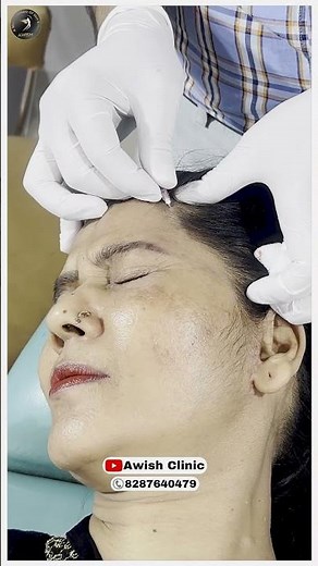 "Thread Lift Before and After: Watch the Amazing Transformation" |Awish Clinic