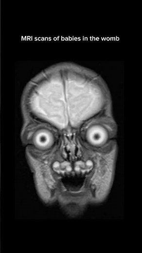 MRI scans of babies in the womb