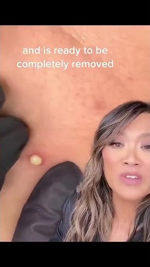 Watch This Pimple Get Removed Safely!