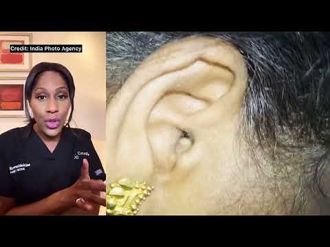 Spider Crawls Out of Ear 🕷: Doctor Reacts