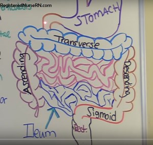 Colostomy & Ileostomy NCLEX Review