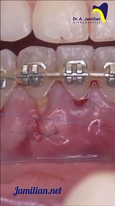 How to Correct Gingival Recession During Orthodontic Treatment #gingiva #recession #periodontics