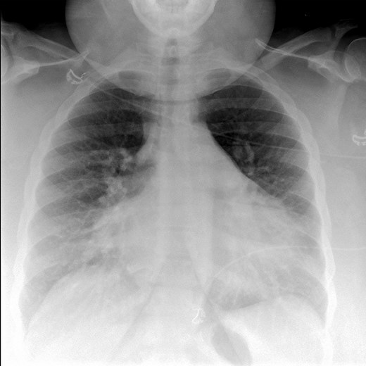 Pulmonary Edema - Cardiovascular Disorders - Merck Manual Professional Edition