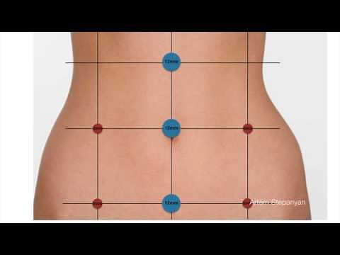 Laparoscopic Pelvic and Aortic Lymphadenectomy