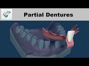 Removable Partial Dentures