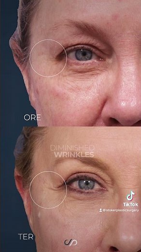 Upper Blepharoplasty Before and After Transformation | Dr. David Stoker