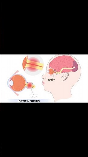 What are signs of optic nerve damage？