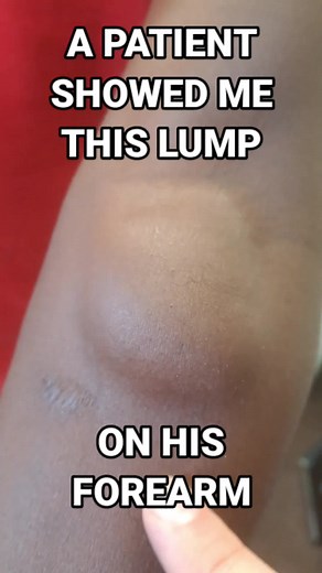 Lump on Forearm: Causes, Symptoms & Treatment