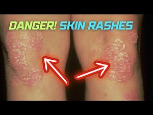Exploring Different Skin Rashes and Their Causes.