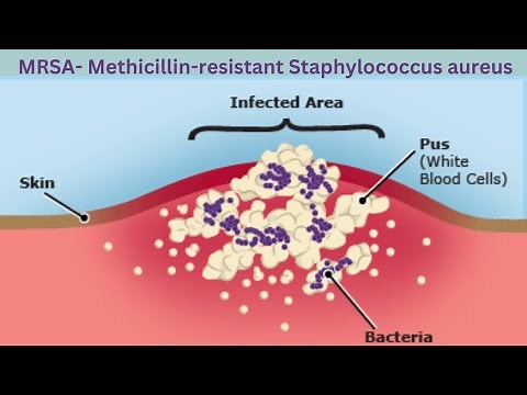 What is MRSA? Methicillin Resistant Staphylococcus Aureus