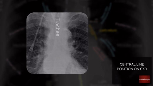 29K views · 232 reactions | CENTRAL LINE POSITION ON CHEST X-RAY In this 7 minute video let’s go through how to review central line position on chest X-Ray. This can be tricky but we’ll go through the CT anatomy first and that I think really helped me get to grips with how to understand what I’m seeing on a chest X-Ray. | The Radiologist | Facebook