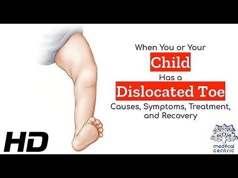 Toe Injuries: How to Handle a Dislocated Toe with Care