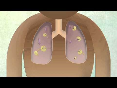 How The Body Reacts To Tuberculosis
