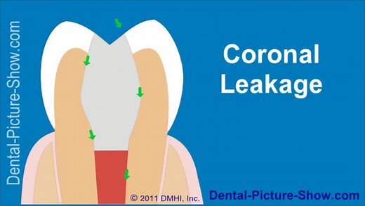 Coronal leakage – A cause of root canal treatment failure.