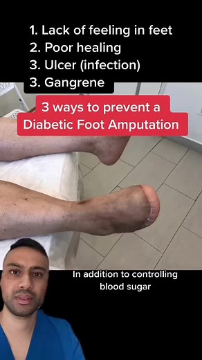 Prevent Diabetic Foot Amputation: 3 Podiatrist Tips