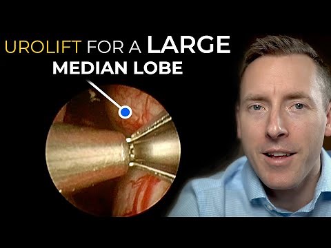 Urolift for a LARGE Median Lobe - I was wrong