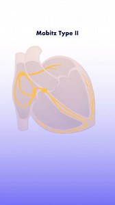 184K views · 466 reactions | Second degree heart block, Mobitz type 2. Follow @cardiovisual for more posts around Cardiology . . Thank you for the post @medzcool #cardiology #cardiacnurse #meded #medzcool #medstudent #nurse #usmlestep1 #medschool #nursing #nursingschool #physicianassistant #doctor #heart #nursepractitioner #medicalassistant #hospital | CardioVisual | Facebook