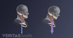 How to Measure and Fix Forward Head Posture