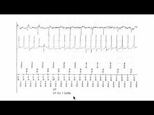Understanding markers and annotations on an ECG.