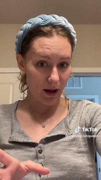 Day 2 post-lancing. No pain or discomfort really. Its a lot flatter! #acne #cysticacne #cyst