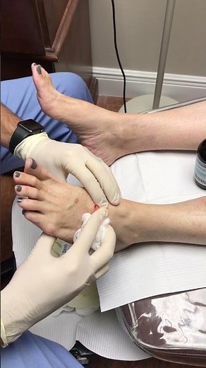Aspiration and Drainage Cyst from Foot