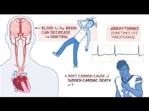 Hypertrophic Obstructive cardiomyopathy echo# symptoms and signs