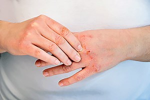 How to prevent and treat hand rashes
