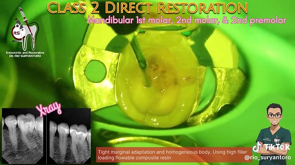 Class 2 restoration in 3 mandibular posterior teeth using high filled flowable composite. 🚀 Having a composite resin with high radiopacity gives several important advantages in dentistry: 1. Clear distinction from tooth structure 🦷 2. Detection of secondary caries 🔍 3. Assessment of restoration margins 4. Monitoring integrity over time 5. Avoids misdiagnosis 🚫 #doktergigi #spesialiskonservasigigi #odontologia #AestheticDentistry