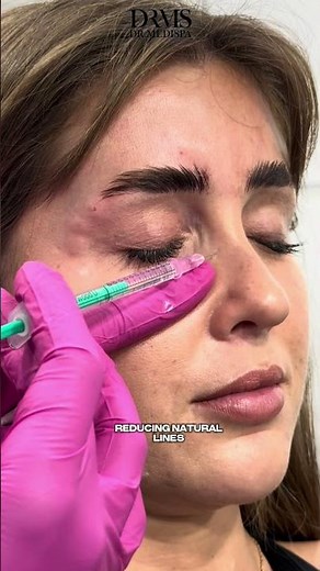 Full Face Botulinum Toxin Injection by Expert Doctor: Prepare to Be Amazed!