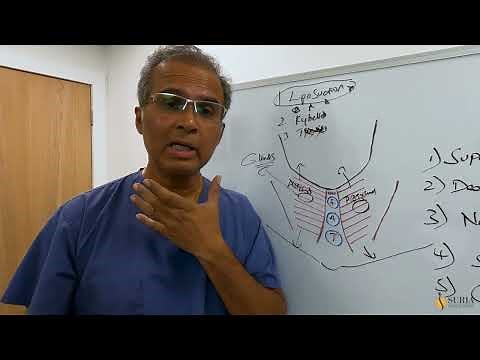 Weston Florida Neck Lift (Platysmaplasty) how it works, what age is best, what to expect.