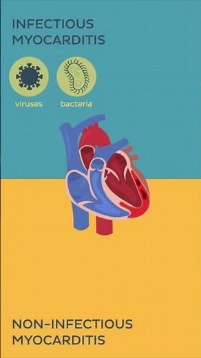 Myocarditis: Causes | Kenhub #shorts