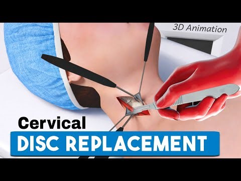 Artificial Cervical Disc Replacement Surgery | 3D Animation | How It Works