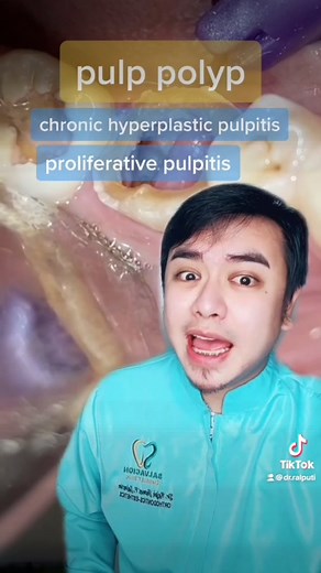 Pulp Polyp Tooth Extraction: Remedies and Treatment