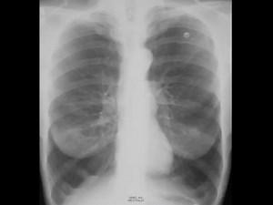 X-ray Sunday Emphysema on Chest X ray | CTisus: Cutting edge information on body CT (Computed tomography). | Facebook